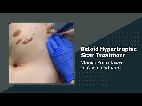 Keloid Hypertrophic Scar Treatment | Vbeam Prima Laser to Chest and Arms| Dr. Jason Emer