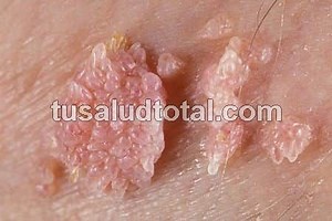 Condilomas Acuminados: Causas, Síntomas y Tratamientos