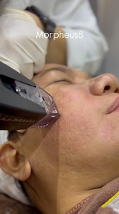 Morpheus8 <Morpheus 8> is an effective procedure for skin...