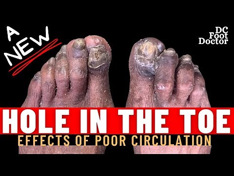 A New Hole In The Toe: Fungal Toenails, Calluses, and Underlying Ulcers