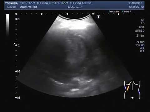 Ultrasound Video showing a mass in Lung with Pleural Effusion. A rare case.