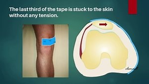 Patella Taping for Excessive Lateral Pressure Syndrome (ELPS)