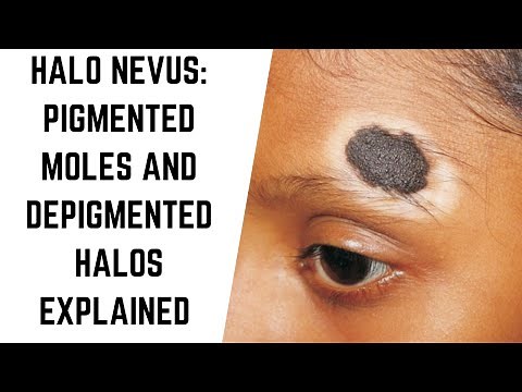 Understanding Halo Nevus: Pigmented Moles and Depigmented Halos Explained #skintreatment