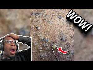 THAT HAS TO HURT! | Pimple Popping Tiktok Compilation 2022