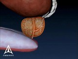 Prostate Biopsy - 3D Medical Animation  • Video • MEDtube.net
