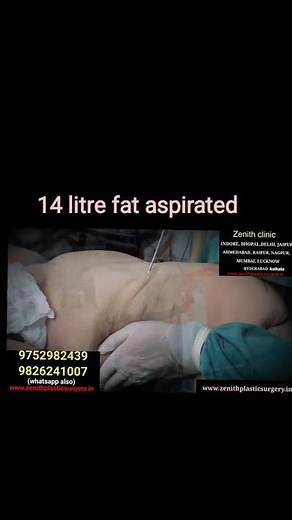 liposuction before and after | live surgery 80kg patient
