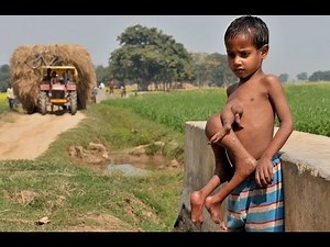 10 People With Extra Body Parts And Deformities