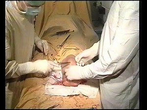 Ампутация голени при критической ишемии