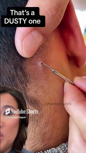 Terminal Hair in Scalp