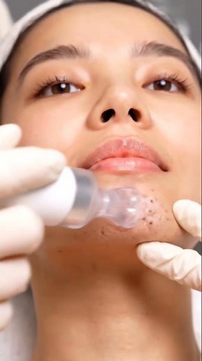 ASMR Chin Blackhead Removal | Real Vacuum Extraction & Deep Pore Cleaning | #asmr #asmrvideo