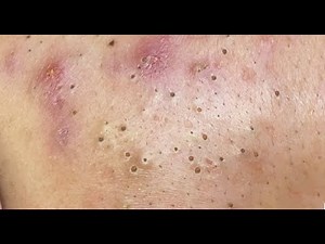 Remove stubborn blackhead acne on your forehead at the best spa #53