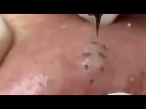 LARGE Blackheads Removal - Satisfying Blackhead 2019 (Part 05)