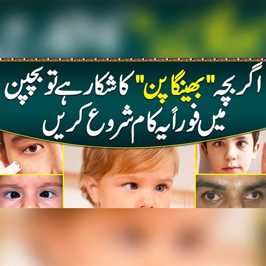17K views · 63 reactions | Squint Eye Causes & Treatment - Ankhon Ka Tedapan or Bhengapan Ka ilaj - Crossed and Squint Eyes | Sehat Mand - Health & Lifestyle | Facebook