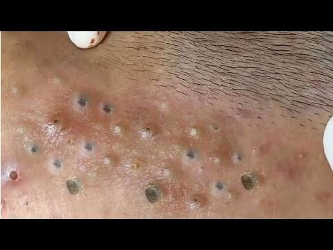 Relax Every Day With Loan Nguyen Spa | Acne Treatment Pimple Popping #34