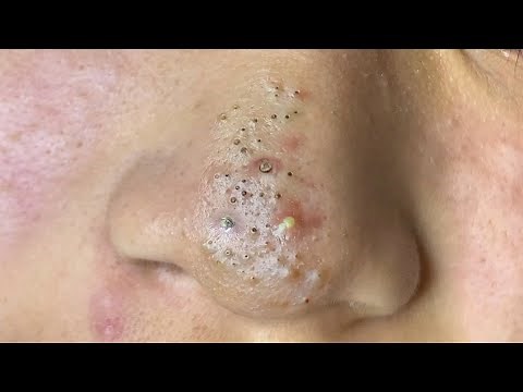 Suri Job #611: Awesome Blackheads And Acne Extraction