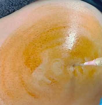 Watch an Injection of PRP into the Hip