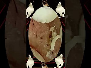 Blackheads Removal #298 | Acne Treatment and Very Satisfying Satisfying Pimple pop #blackheads