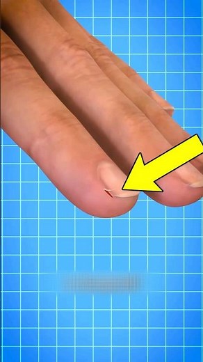 If You've Ever Had A Hangnail, You NEED To See This (Causes, Treatment and Prevention) 🥸