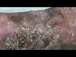 Maggot wound in Casualty theatre