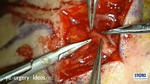 Corneal neurotisation - Oculoplastic | EyeSurgeryVideos.net