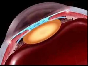 Eye pharmacy. Glaucoma. Travatan, Alcon.