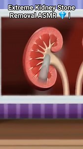 5.6K views · 15 reactions | Extreme Kidney Stone Removal ASMR  | Oddly Satisfying #reels #satisfying #trending #video #shorts | Akhilesh Yadav | Facebook