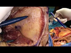 Pterional Craniotomy with Ravi Nunna, MD & Matias Costa, MD