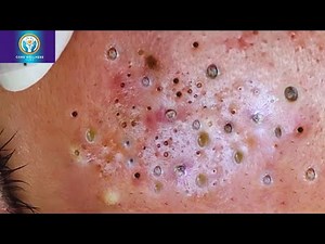 I&D for Severe Cystic Acne: STOP Pain INSTANTLY with The ZERO SCAR Formula