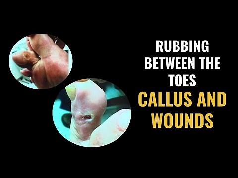 Rubbing Between The Toes - Calluses and Wounds