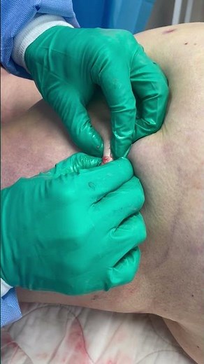 What Are Lipedema Nodules?