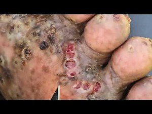 Robert Livingstone's 3rd jigger dig #2 - see long vids @ riseupsociety.net & ruskenya.org