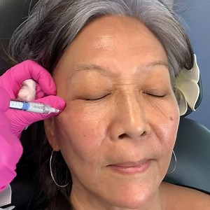 Cheek filler on this beauty 😍✨ I love using cheek fillers to contour and lift the cheeks and prevent heavy lower face jowling. Some people worry about getting chubby or round chipmunk cheeks with fillers, but if done correctly by a certified injector, filler can give you slimmer and contoured cheeks! You would love cheek filler if: ✨heavy jowling ✨Nasolabial folds ✨less dimensional face ✨want restorative volume ✨want mode to lesque cheekbones Come see me and book your appt ❤️ 💉❤️✨💉❤️✨💉 To se