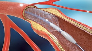Medical Tubing and Catheters | Optical Thickness Gauge Applications