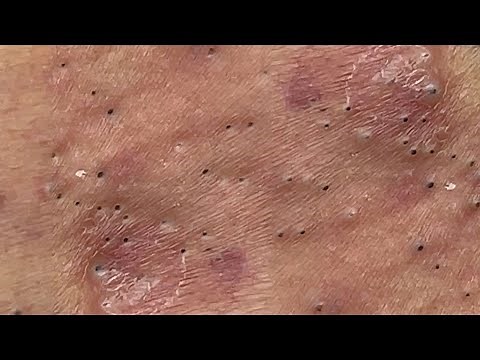 Suri Job #599: Awesome Blackheads Extraction