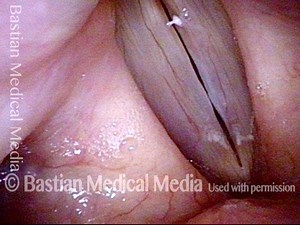 Mucosal Edema (Swelling) - Precursor to Vocal Nodules (photos)