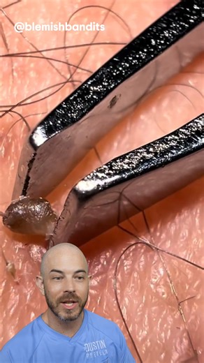 This pore of winer extraction left us hanging😣! (credit: @blemishbandits on TT) #doctor #satisfying | Dr. Dustin Portela, Dermatologist