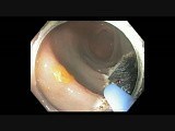Colonoscopy - Transverse Colon - EMR • Video • MEDtube.net