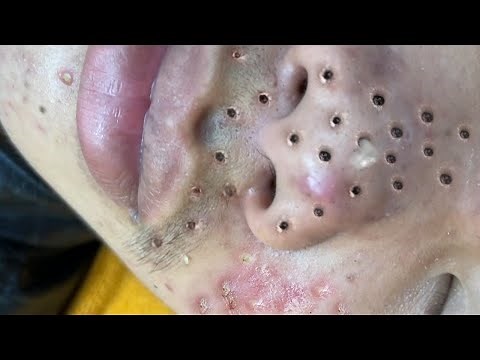 Blackhead Removal With Sac Dep Spa @1000377