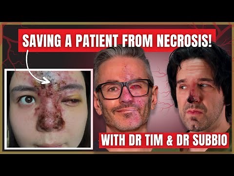 Managing Vascular Occlusions: Dr. Subbio's Success Story in Saving a Patient from Necrosis