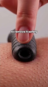 How to Remove a Leech Safely (The Right Way)