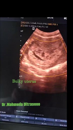 💥A molar pregnancy, also known as a hydatidiform mole, is an abnormal form of pregnancy in which a non-viable fertilized egg implants in the uterus. 💥 It falls under the category of gestational trophoblastic diseases, 💥The two main types: complete and partial molar pregnancy. 💥In women with a complete mole, the quantitative serum beta-hCG level is higher than expected, often exceeding100,000 IU/L. 💥Common Complications:SevereBleeding,Preeclampsia,Ovarian Cysts , Hyperthyroidism ,Invasive Mo