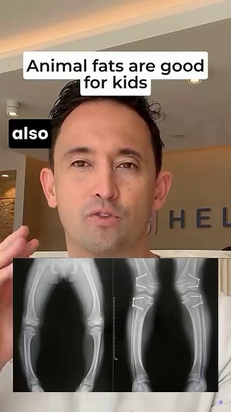 6.8K views · 122 reactions | Did you know rickets is on the rise? In...