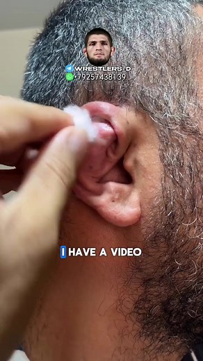 Comprehensive Tutorial on Managing Cauliflower Ear