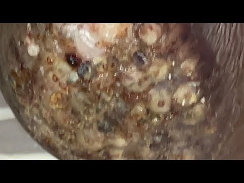 Jigger digging Wafula’s many little jiggers on the second knee (2 of 4)