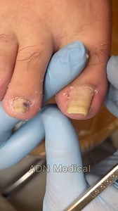 73K views · 288 reactions | Satisfying Toenail Trim for Clean Foot Care #ToeCare #ToenailTrim #GroomingRoutine #CleanNails | ADN Medical | Facebook