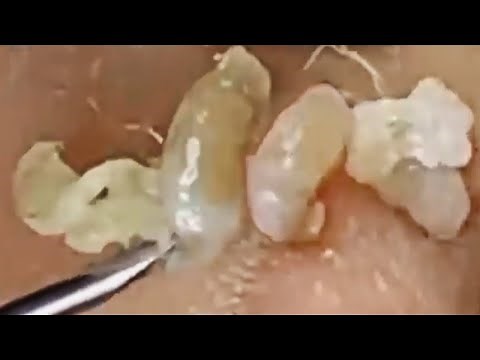 Deep blackhead extraction Cystic acne & pimple popping #10