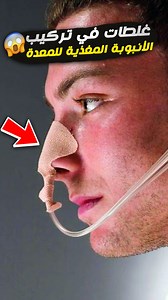 493K views · 5.7K reactions |  غلطة صغيرة في تركيب الـ NG Tube ممكن تــ.ـقتل المريض! – NG Tube Placement Gone Wrong #NG_Tube #انبوبة_المعدة #تمريض #nursing #critical_care #patient_safety #medical_skills #التمريض #رعاية_المرضى #nurse_life #خطوات_التركيب #medical_education #emergency_care | إيجي نيرسولوجي - EgyNursology | Facebook