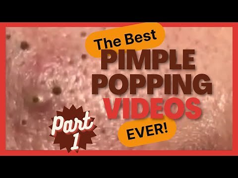 The BEST pimple POPPING videos EVER (p1)