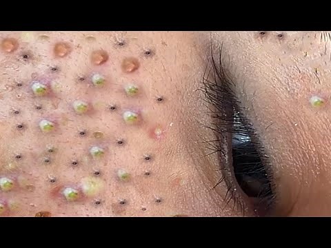 Relax Every Day With Loan Nguyen Spa | Acne Treatment Pimple Popping #44