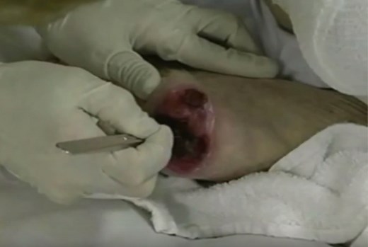 Types of Wound Debridement